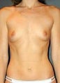 Bilateral Breast Implants
