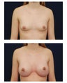 Breast Augmentation
