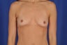 Breast Augmentation