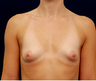 Breast Augmentation