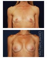 Breast Augmentation