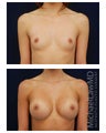 Breast Augmentation