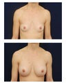 Breast Augmentation