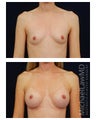 Breast Augmentation