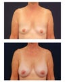 Breast Augmentation