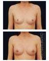 Breast Augmentation
