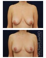 Breast Augmentation with Lift