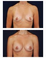 Breast Augmentation