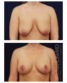 Breast Augmentation
