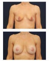 Breast Augmentation with Lift