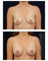 Breast Augmentation