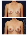 Breast Augmentation