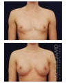Breast Augmentation