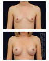 Breast Augmentation
