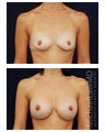 Breast Augmentation