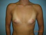 Breast Augmentation with Silicone Gel Implants