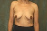 Women's Breast Augmentation: Enlarge and Minilift