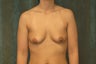 Women's Breast Augmentation: Enlarge and Minilift