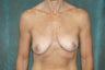 Women's Breast Augmentation: Enlarge and Minilift