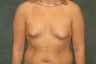 Women's Breast Augmentation: Enlarge and Minilift