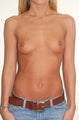 Breast Augmentation