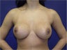 Breast augmentation