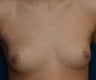 Breast Augmentation