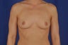 Peri-areolar Breast Augmentation