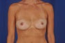 Asymmetrical Breast Augmentation
