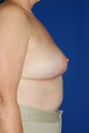 Heavy breast treatment, implant removal and breast lift
