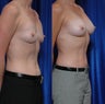 Breast implant removal and fat grafting