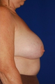 Heavy breast treatment, implant removal and breast lift