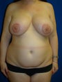 Liposuction and Implant Revision Surgery