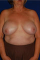 Breast Implant Removal