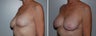 Breast implant revision