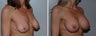 Breast implant revision