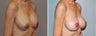 Breast Implant Revision