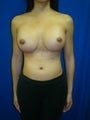 Revision Breast Surgery