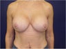 Breast Implant Revision