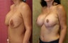 breast implant revision