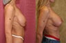breast deflation
