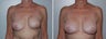 Breast implant revision