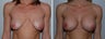 Breast implant revision