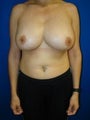 Revision Breast Surgery