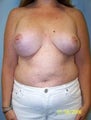 Revision Breast Surgery