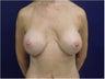 Breast Implant Revision