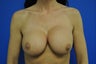 Breast Implants/Augmentation Revision