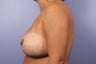 Breast Implant Revision