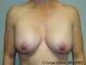 Breast Augmentation