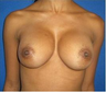 Breast Augmentation
